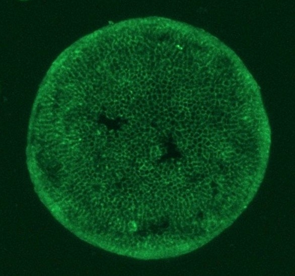 Cancer Organoid